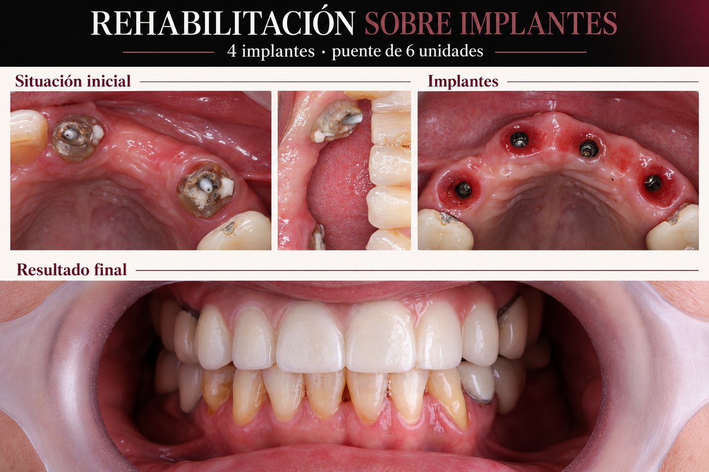 Caso real Dental Advance: rehabilitación sobre implantes, 4 implantes y puente de 6 unidades, situación inicial y resultado final